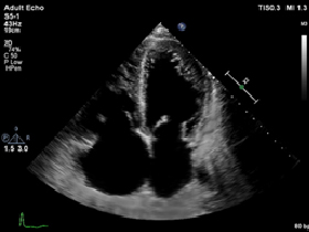 心臓超音波検査での超音波画像